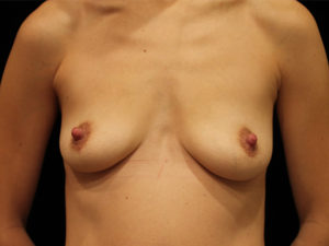 breast augmentation patient
