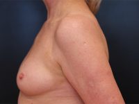 breast augmentation patient