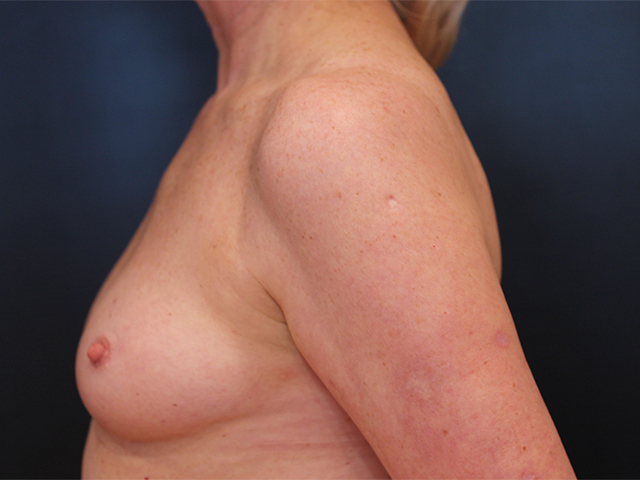 breast augmentation patient