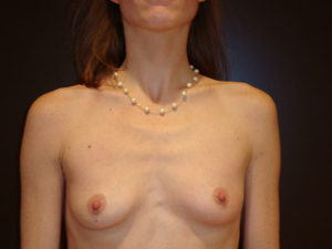 breast augmentation patient