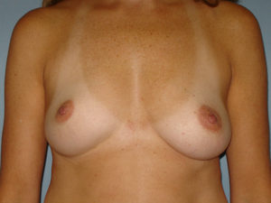 breast augmentation patient