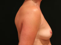 breast augmentation patient