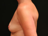 breast augmentation patient