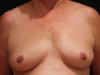 breast augmentation patient
