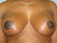 breast lift patient