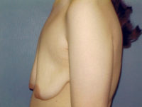breast lift patient