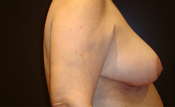 breast reduction patient