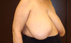 breast reduction patient