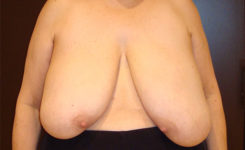 breast reduction patient