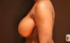 breast reduction patient