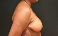 breast reduction patient