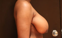 breast reduction patient