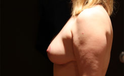 breast reduction patient