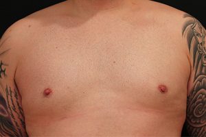 male breast reduction patient