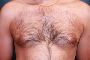 male breast reduction patient