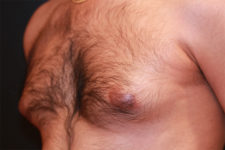 male breast reduction patient