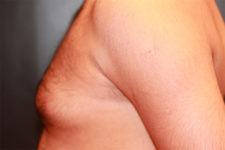 male breast reduction patient