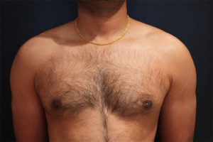 male breast reduction patient