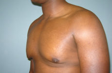male breast reduction patient