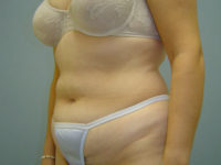 tummy tuck patient