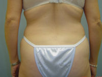 tummy tuck patient