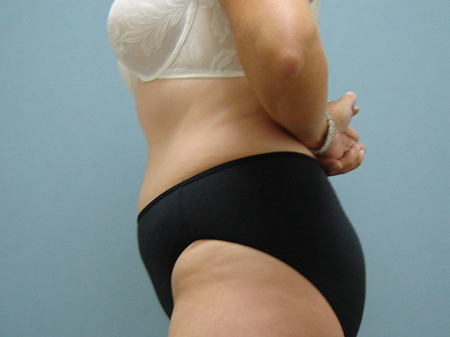 tummy tuck patient