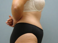 tummy tuck patient