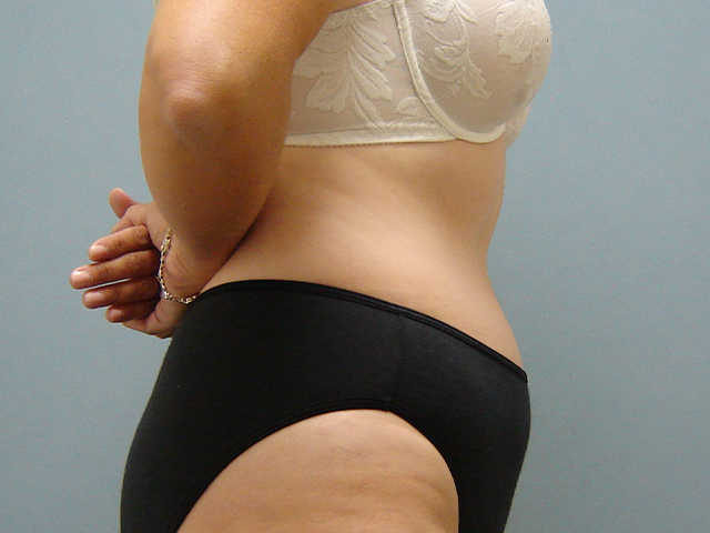 tummy tuck patient