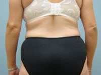tummy tuck patient