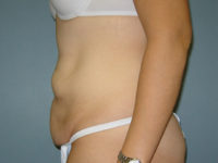 tummy tuck patient