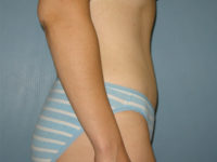 tummy tuck patient