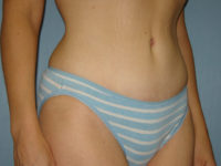tummy tuck patient