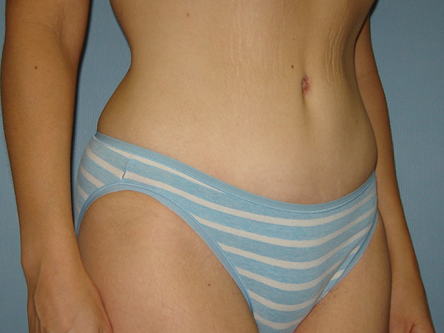 tummy tuck patient