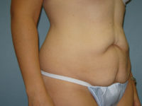 tummy tuck patient