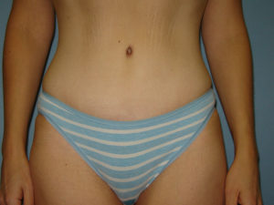 tummy tuck patient