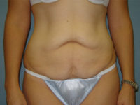 tummy tuck patient