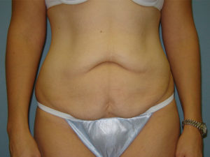 tummy tuck patient