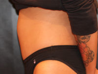 tummy tuck patient