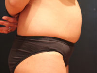 tummy tuck patient