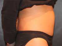 tummy tuck patient