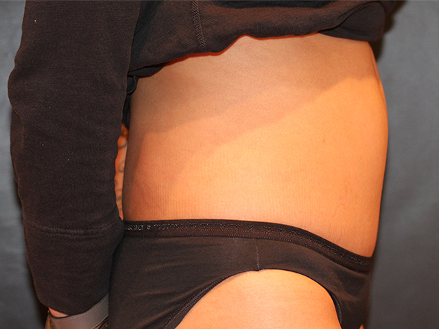 tummy tuck patient