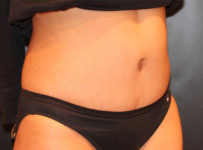 tummy tuck patient