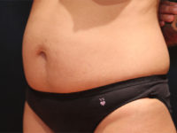 tummy tuck patient