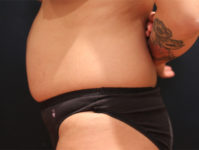 tummy tuck patient