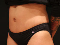 tummy tuck patient