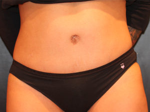 tummy tuck patient