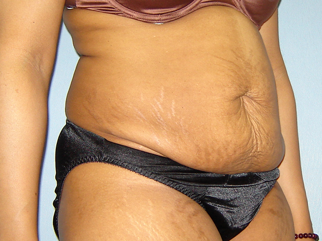 tummy tuck patient