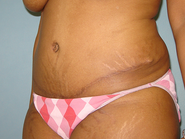 tummy tuck patient