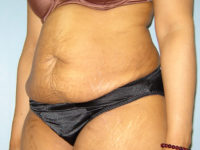 tummy tuck patient