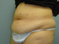tummy tuck patient